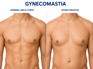 Gynecomastia surgery in hisar