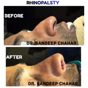 Rhinoplasty Surgery in Hisar