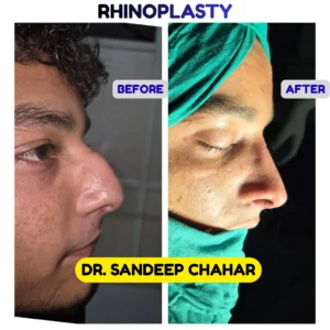 Rhinoplasty Surgery in Hisar