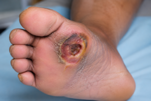 diabetic foot treatment in Hisar