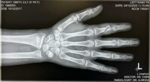 Child Hand Injury Specialist in Hisar